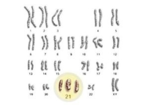 Evidenziazione del cromosoma 21 che causa la sindrome di Down