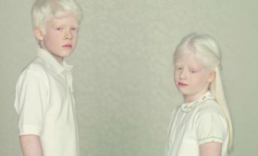 Un ragazzo e una bimba con albinismo