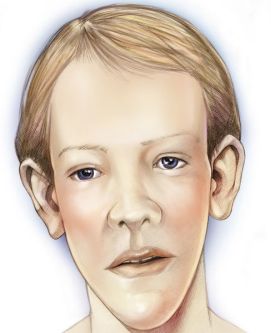 Disegno raffigurante l'aspetto tipico di un ragazzo con la sindrome di Sotos (©Mayo Foundation for Education and Research)