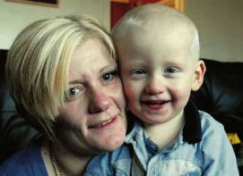 Un bimbo affetto da albinismo con la madre