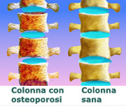 Immagine raffigurante colonna vertebrale sana e con osteoporosi