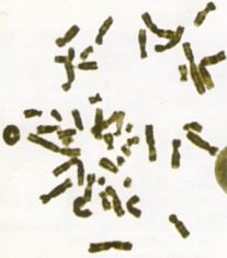 Il cromosoma della sindrome RING 14