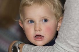 Una bimba affetta da sindrome di Rett