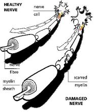 Il meccanismo di distruzione delle guaine mieliniche che causa il rallentamento o il blocco degli impulsi dal sistema nervoso centrale fino alle varie parti del corpo e viceversa
