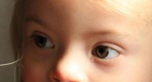 Primo piano di occhi di una bimaba con sindrome di Down