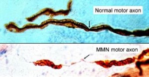 Processo di demielinizzazione dell'assone motorio nella neuropatia motoria multifocale (MMN)
