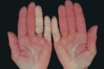 Un esempio del fenomeno di Raynaud (o "delle mani fredde e delle dita viola"), uno dei sintomi tipici della sclerodermia (sclerosi sistemica)