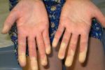 Il cosiddetto "fenomeno di Raynaud" (o "delle mani fredde e delle dita viola"), contraddistinto dal fatto che con il freddo, le mani e/o i piedi diventano bianchi e perdono la sensibilità. Si tratta di uno dei primi sintomi della sclerosi sistemica progressiva o sclerodermia