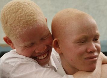 Due ragazzi africani albini