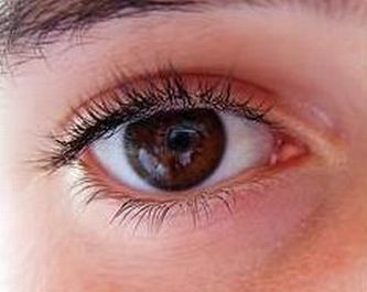Occhio di una giovane affetta da retinite pigmentosa