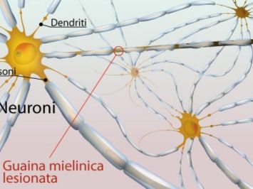 Demielinizzazione che causa la sclerosi multipla