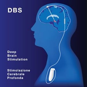 DBS ("stimolazione cerebrale profonda)