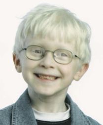 Un bimbo affetto da albinismo oculo-cutaneo