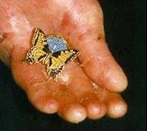 Sono detti anche «bambini farfalla» i piccoli pazienti affetti da epidermolisi bollosa