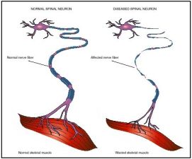 Nell'immagine un motoneurone malato (a destra) in fase di degenerazione, processo che contraddistingue la sclerosi laterale amiotrofica