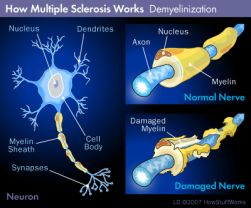 Processo di demielinizzazione nella sclerosi multipla